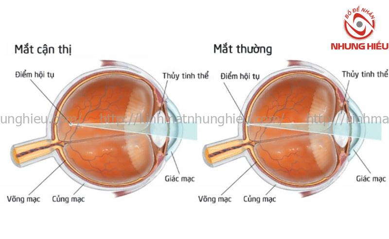 kính cận là thấu kính gì
