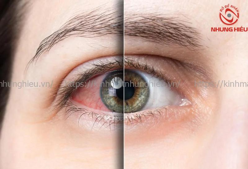 đeo kính áp tròng bị cay mắt