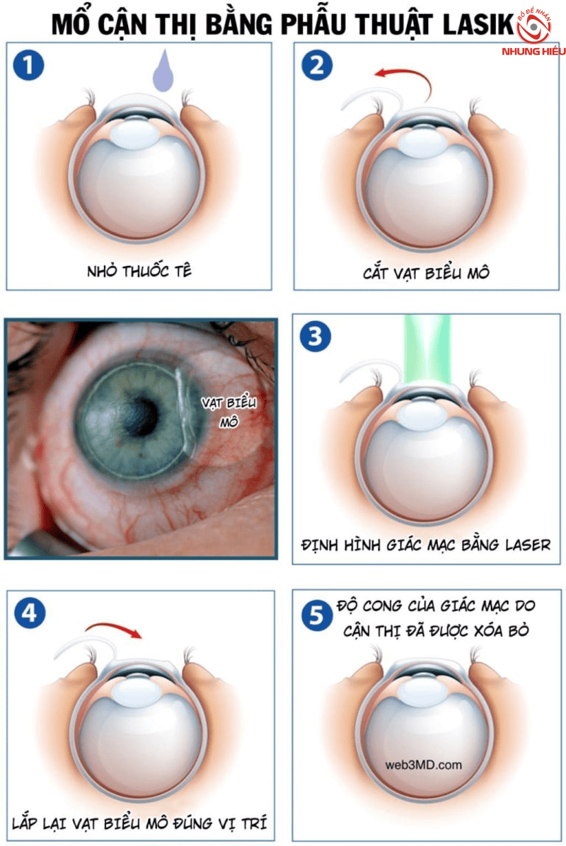 Các bước thực hiện phương pháp LASIK