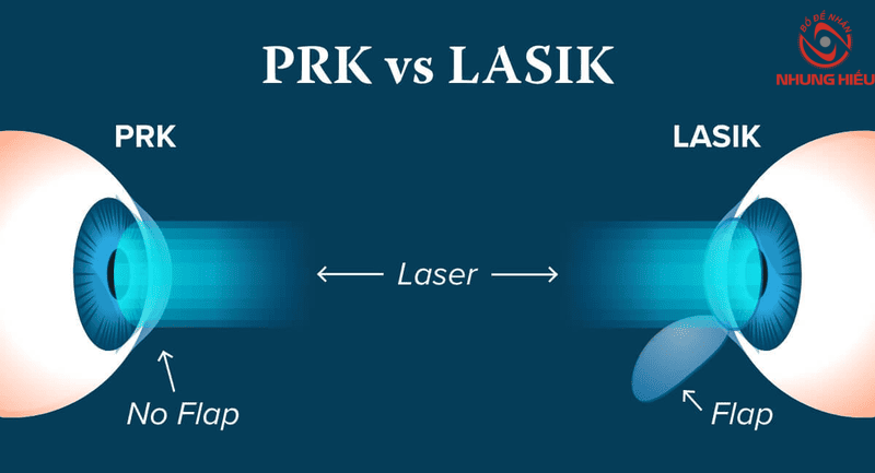 Sự khác nhau giữa PRK và LASIK