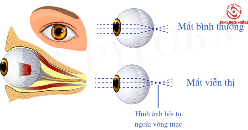 Viễn thị là gì