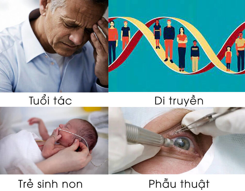 Nguyên nhân gây chứng loạn thị là gì