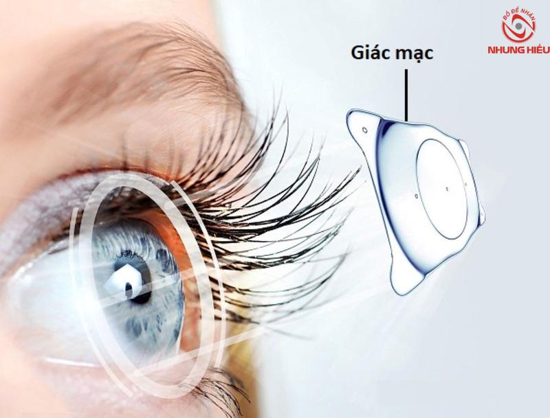 Viễn thị có mổ được không