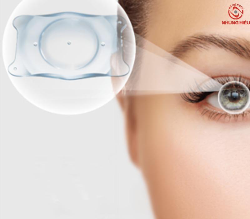mắt viễn thị có mổ được không