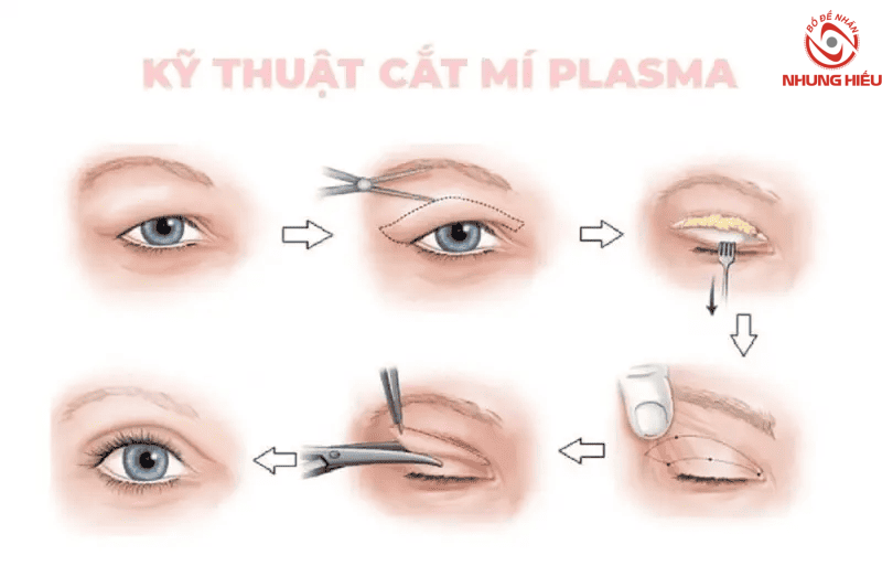 Phương pháp cắt mí mắt lươn