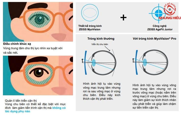 Tròng kính ZEISS Myovision Pro kiểm soát cận thị ở trẻ nhỏ 1 Tròng kính ZEISS MyoVision Pro là gì