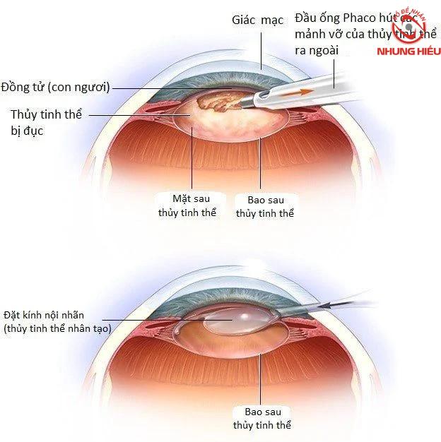 Mắt nhìn đèn thấy quầng sáng do đục thuỷ tinh thể Mắt nhìn bóng đèn thấy quầng sáng